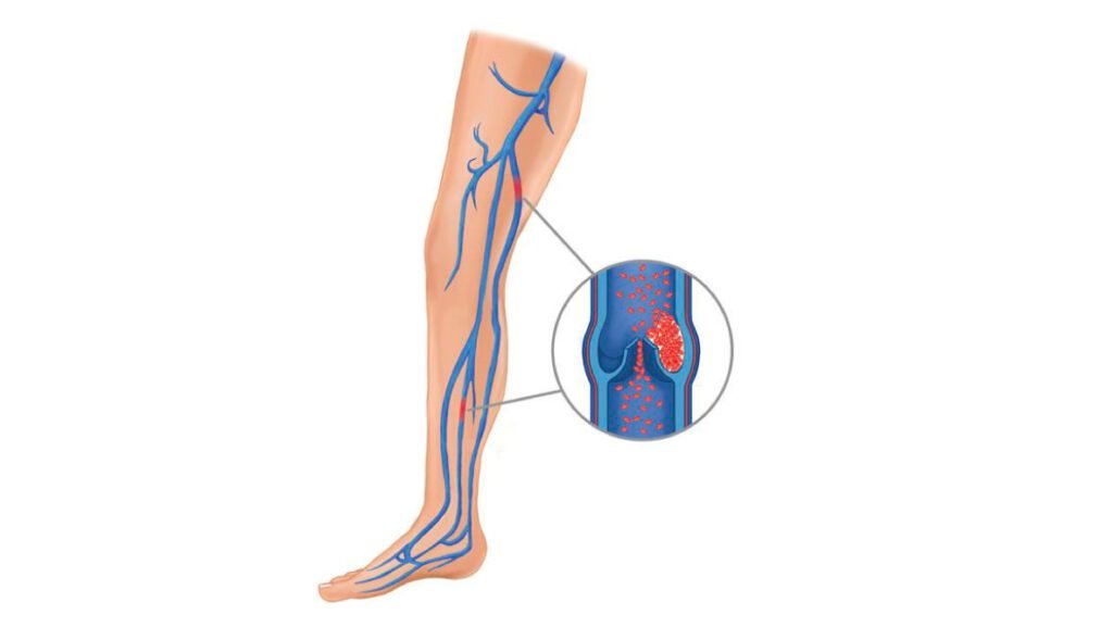 Síndrome postrombótico