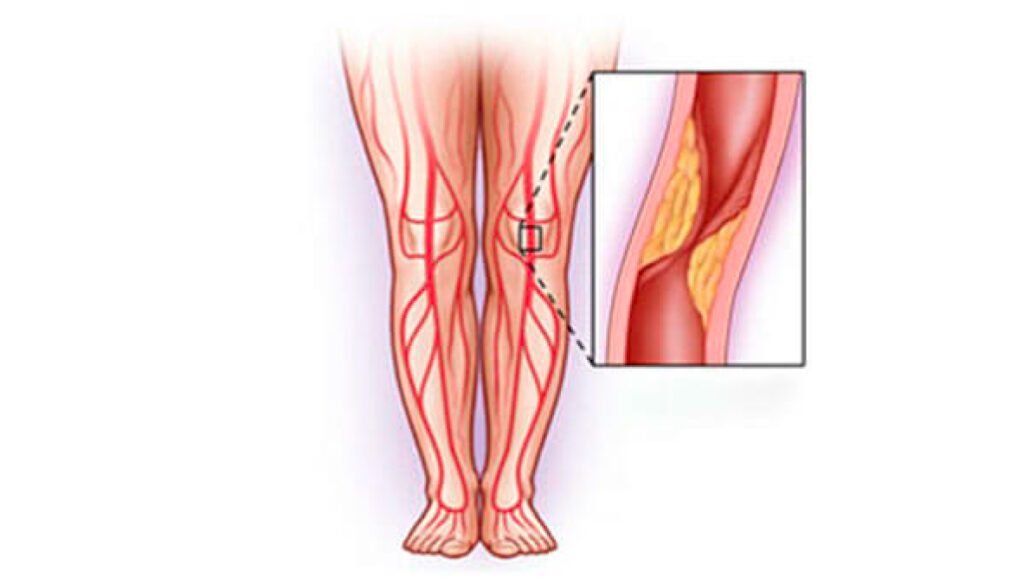 Enfermedad-arterial-periférica-(EAP)