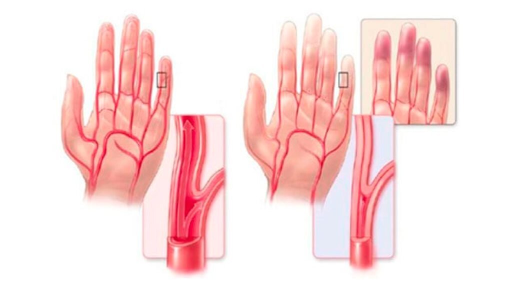 Enfermedad-de-Raynaud