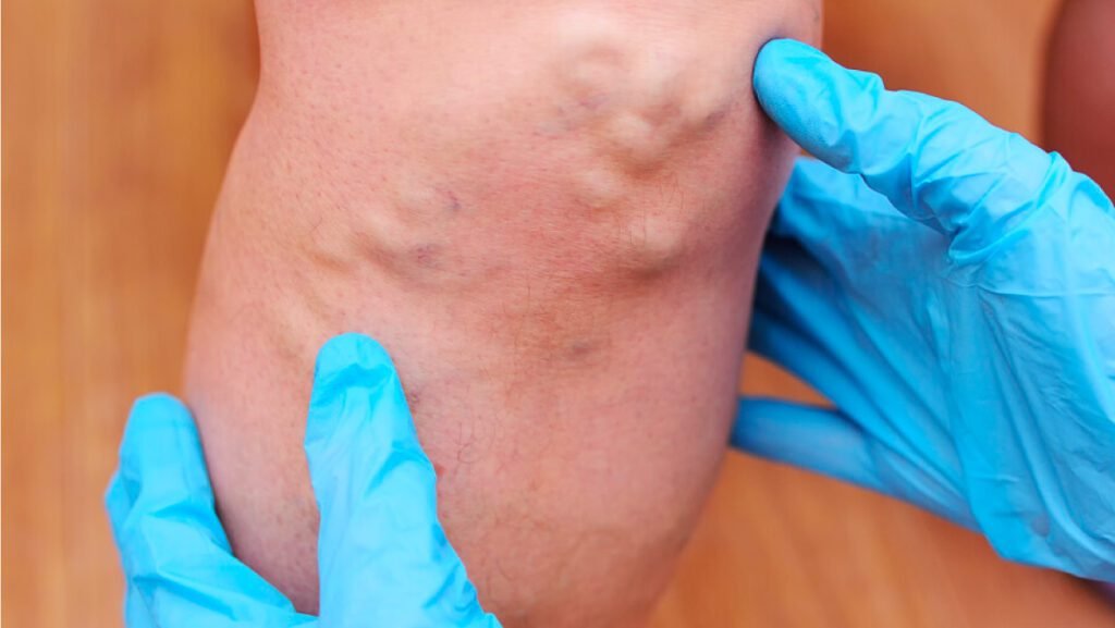 Trombosis venosa profunda (TVP)